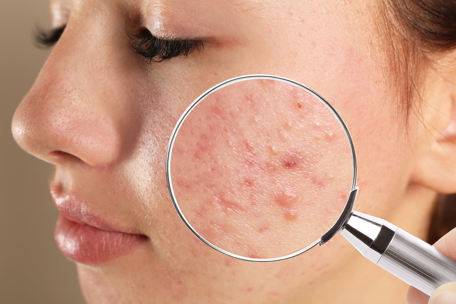 Adult Acne Treatment